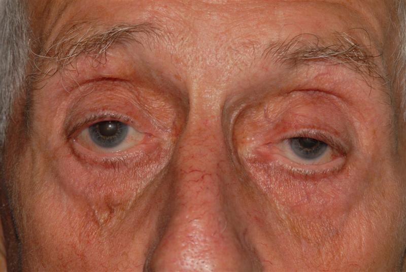 Ptosis (drooping) of the upper eyelid – BOPSS