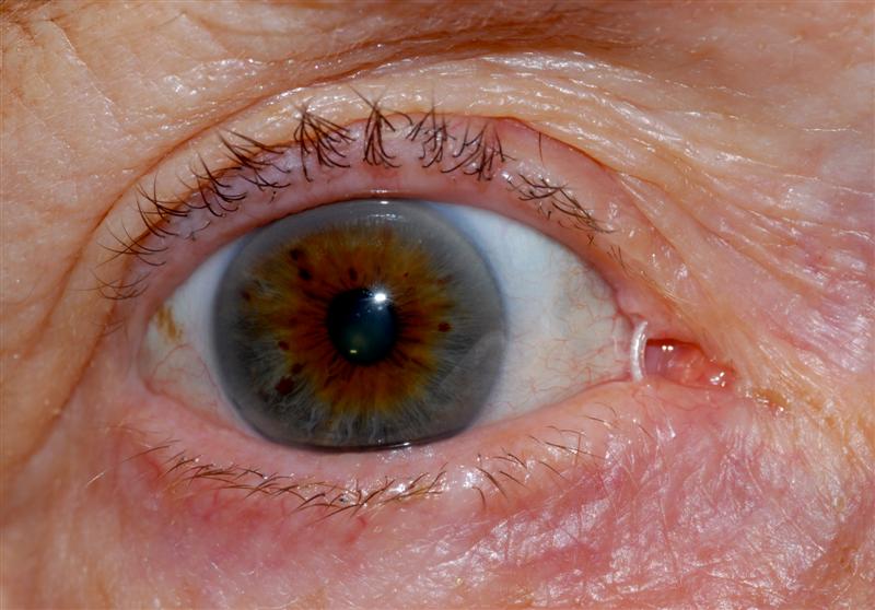 Watery Eye - BOPSS